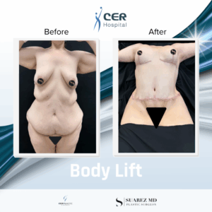 Body Lift – 070126