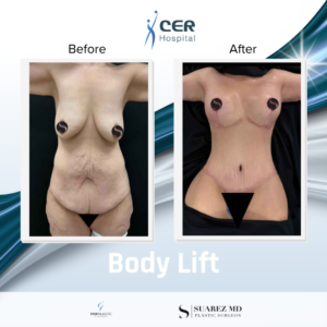 Body Lift – 160126