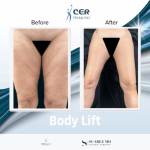 Body Lift – 130126