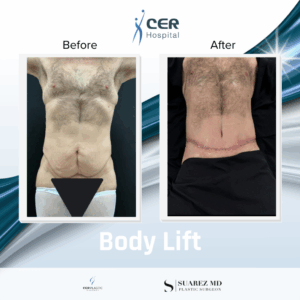 Body Lift – 050126