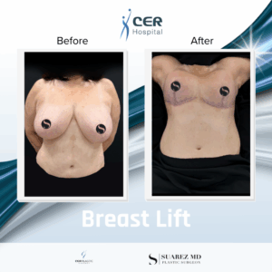 Breast Lift – 150126