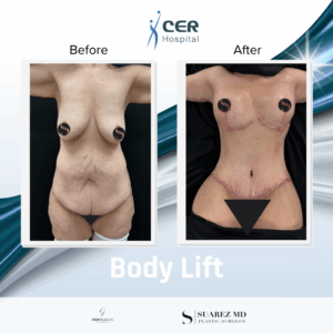 Body Lift – 160126