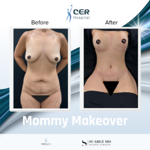 Mommy Makeover – 191225