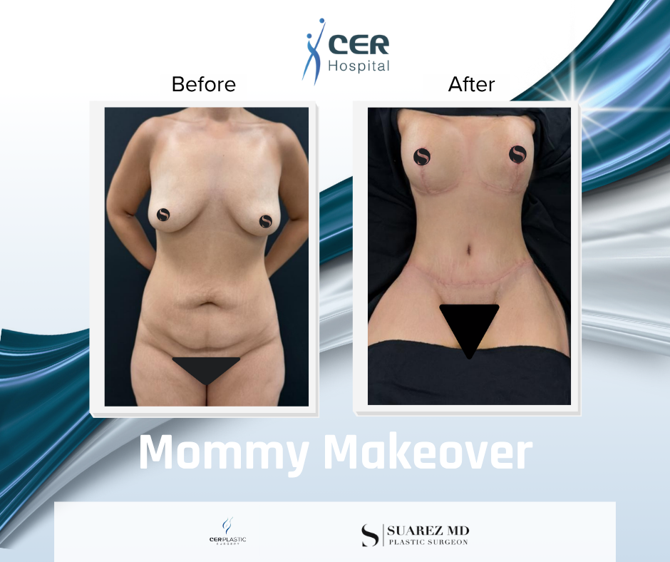 Mommy Makeover - 191225