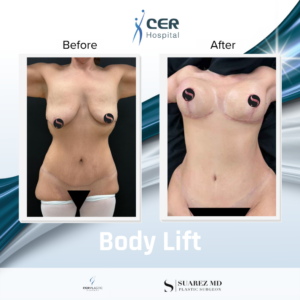 Body Lift – 080126