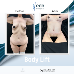 Body Lift – 070126