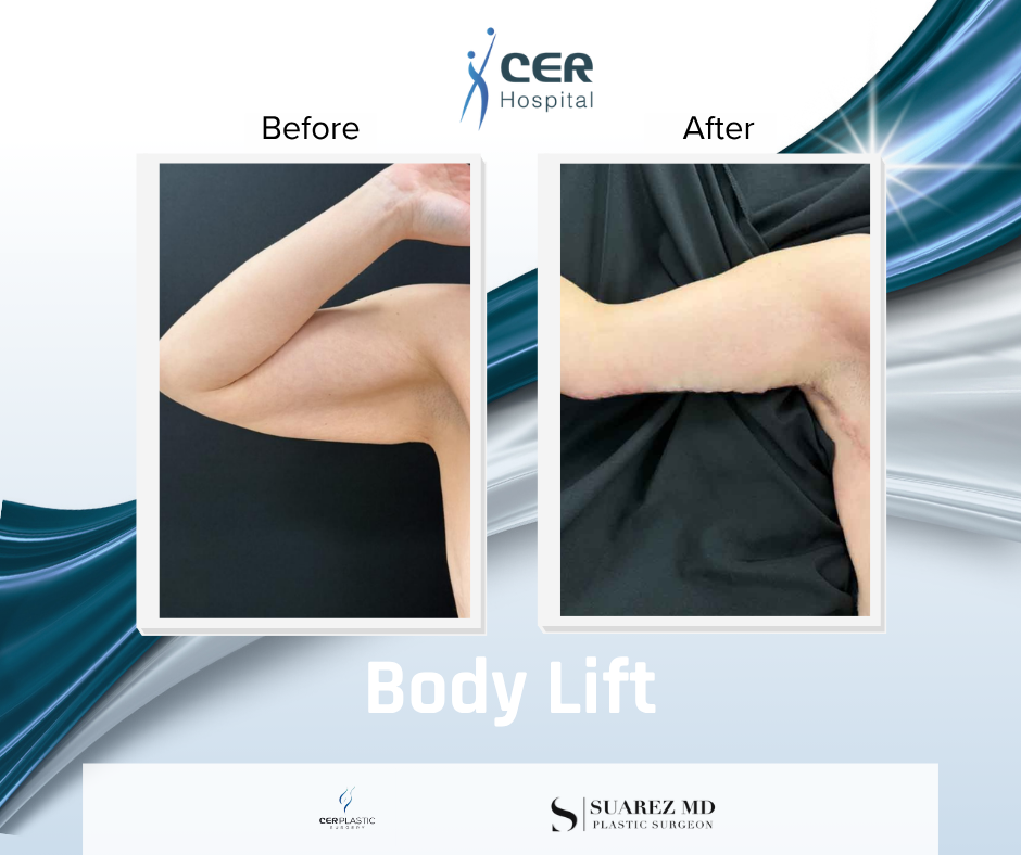 Body Lift - 160126 - Image 10