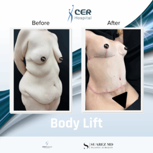 Body Lift – 070126