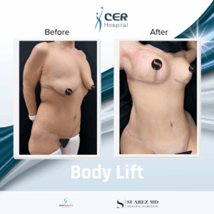 Body Lift – 080126