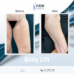 Body Lift – 130126