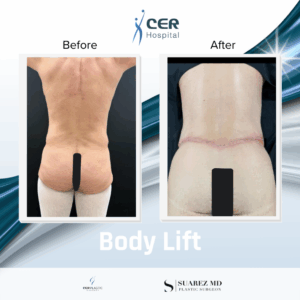 Body Lift – 050126