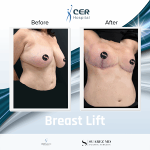 Breast Lift – 150126