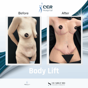 Body Lift – 160126