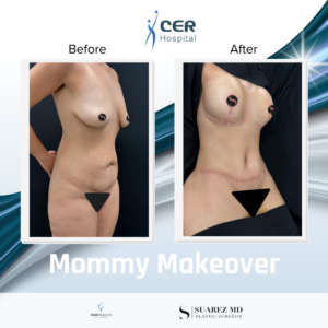 Mommy Makeover – 191225