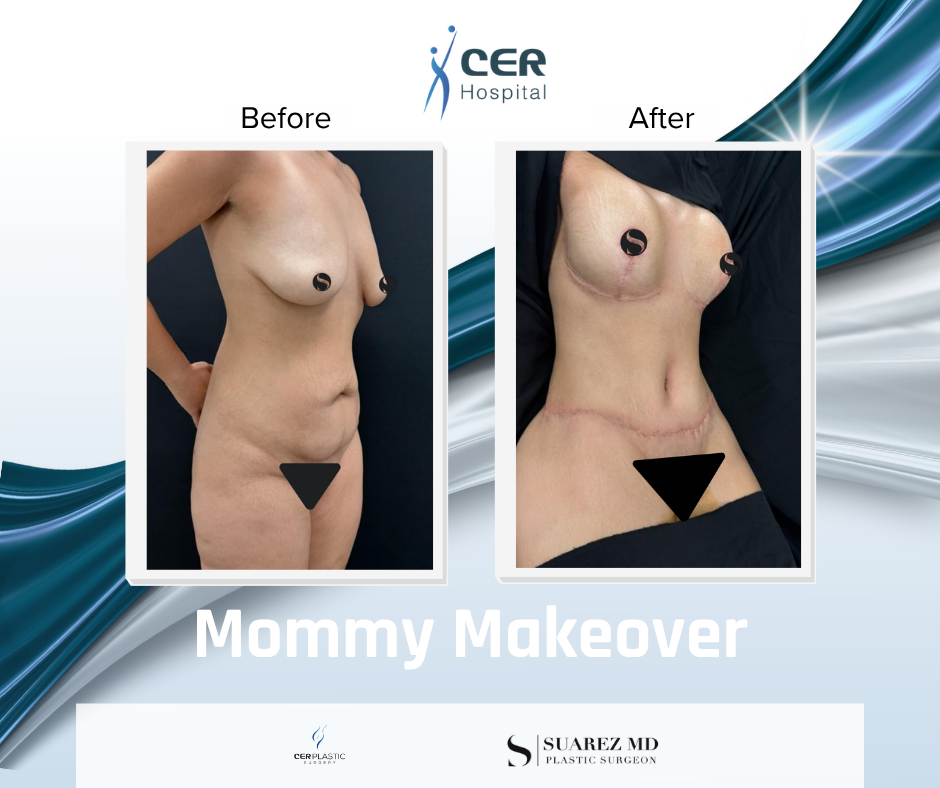 Mommy Makeover - 191225 - Image 2