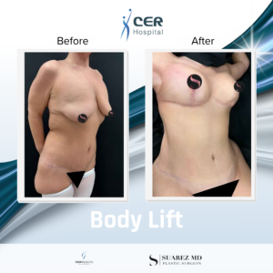 Body Lift – 080126