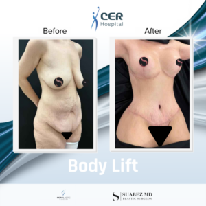 Body Lift – 160126
