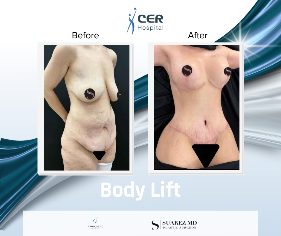 Body Lift - 160126 - Image 2