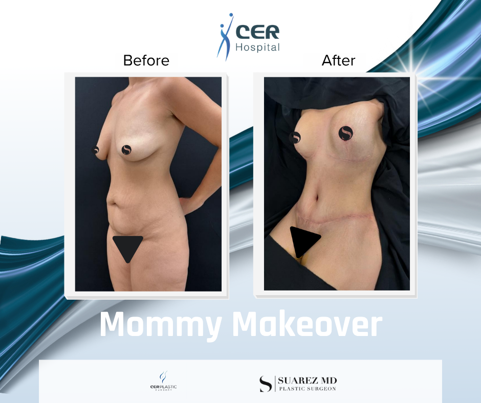 Mommy Makeover - 191225 - Image 3
