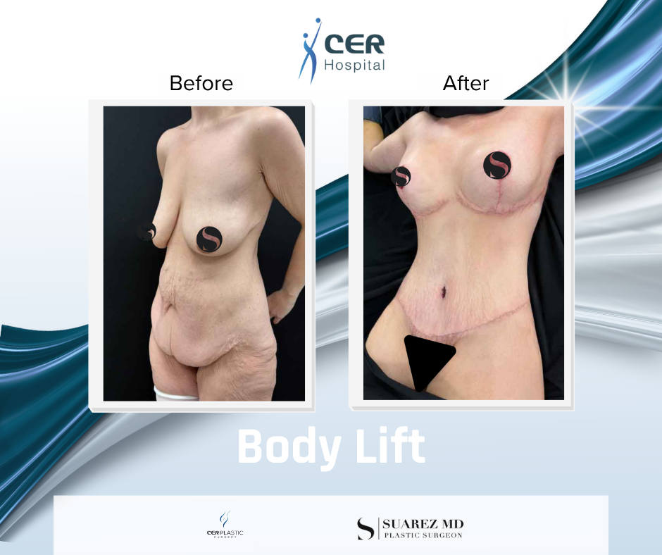Body Lift - 160126 - Image 3