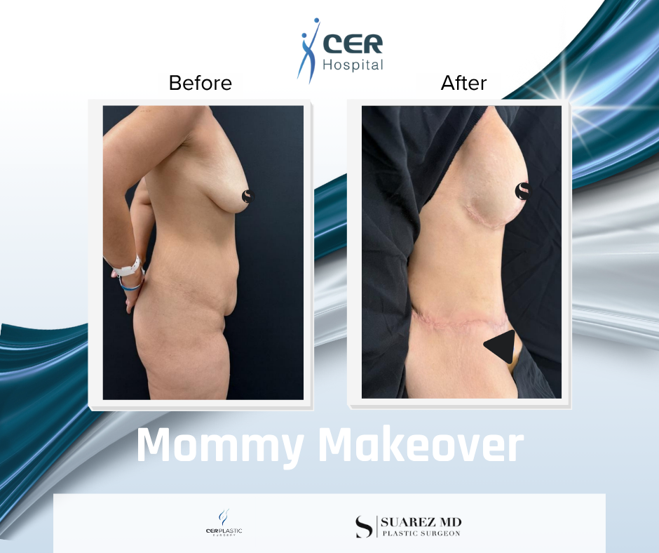 Mommy Makeover - 191225 - Image 4