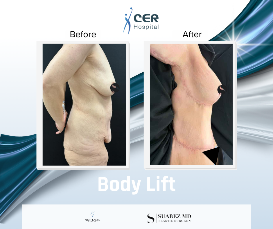Body Lift - 160126 - Image 4