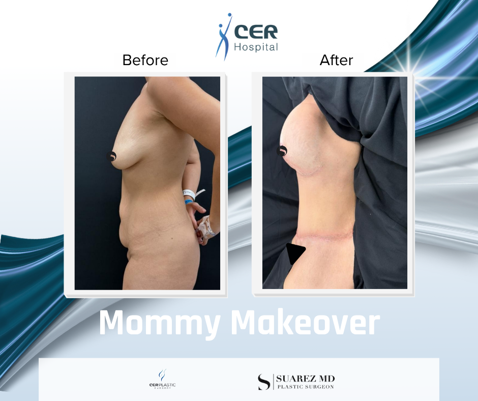 Mommy Makeover - 191225 - Image 5