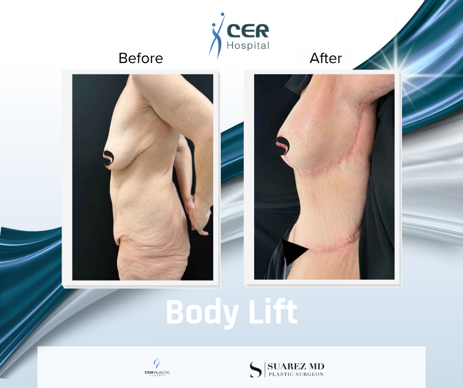 Body Lift - 160126 - Image 5