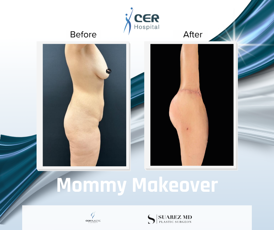 Mommy Makeover - 191225 - Image 6