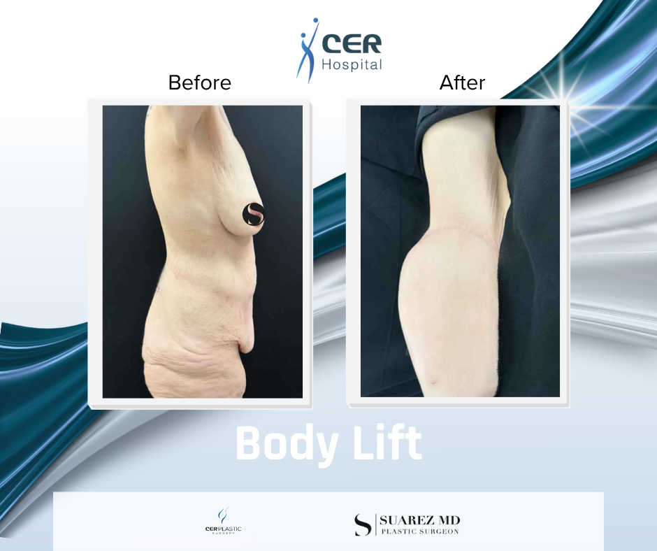 Body Lift - 160126 - Image 6