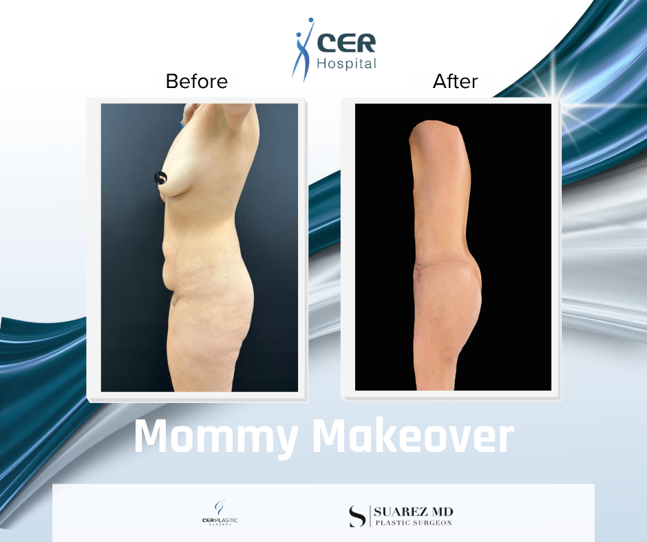 Mommy Makeover - 191225 - Image 7