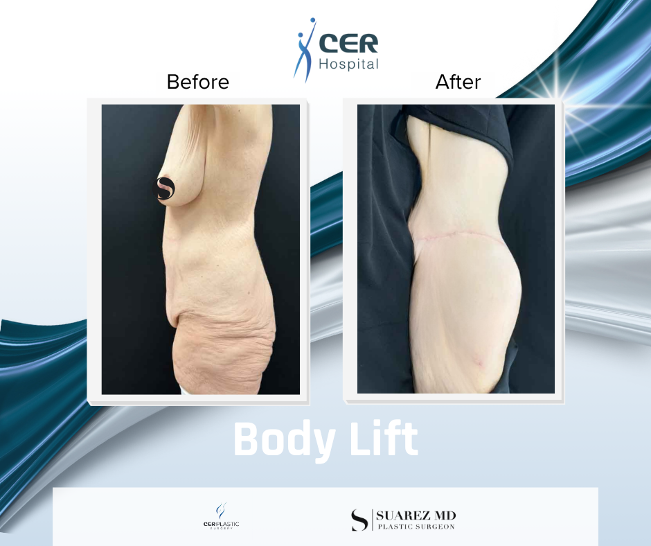 Body Lift - 160126 - Image 7
