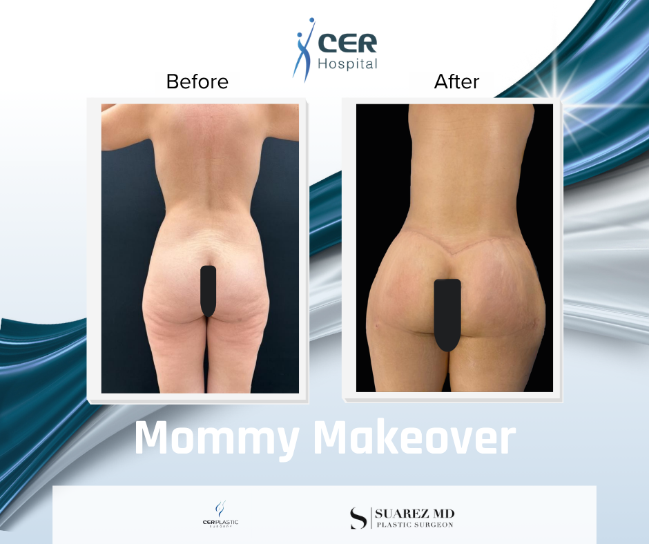 Mommy Makeover - 191225 - Image 8