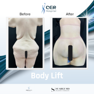 Body Lift – 070126