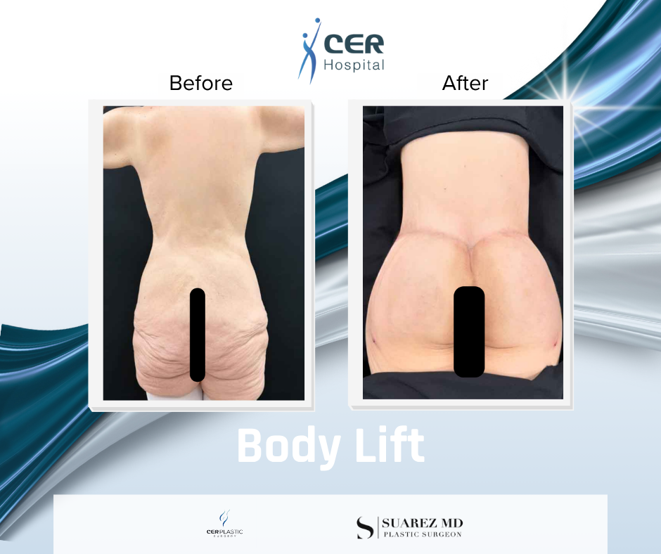 Body Lift - 160126 - Image 8