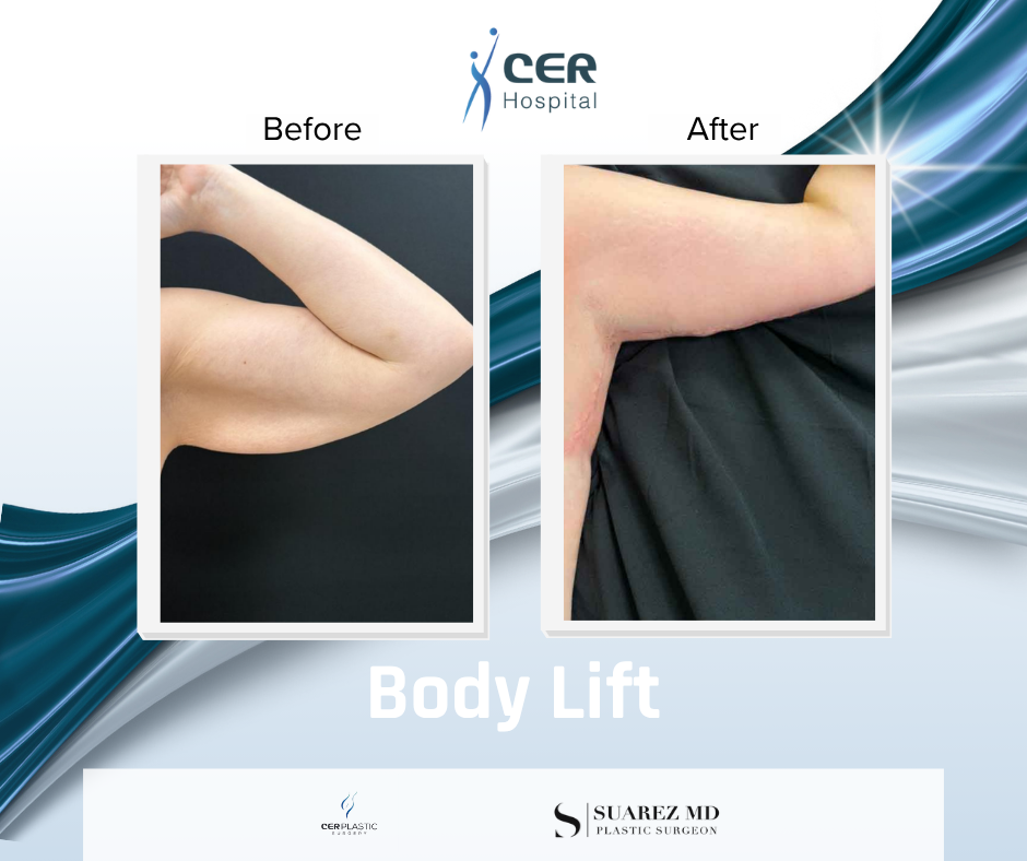 Body Lift - 160126 - Image 9