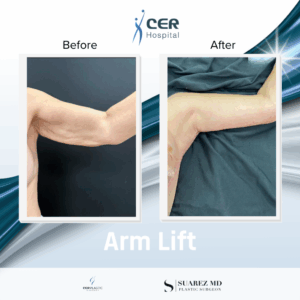 Arm Lift – 290126
