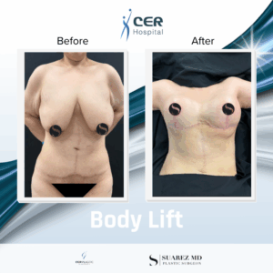 Body Lift – 090226