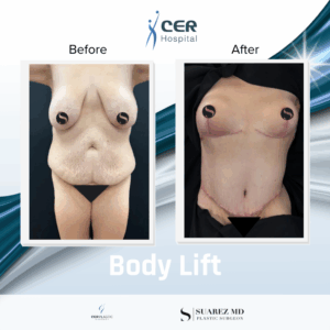 Body Lift – 060226