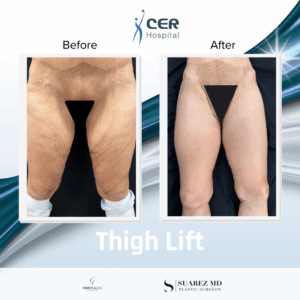 Thigh Lift – 091225