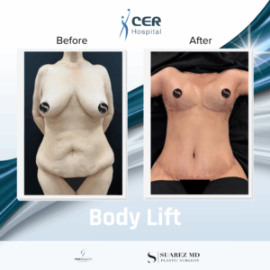 Body Lift – 170226