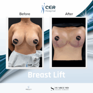 Breast Lift – 180226