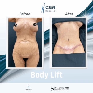 Body Lift – 270126