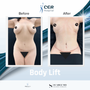 Body Lift – 030226