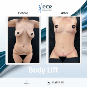 Body Lift – 280126