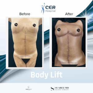 Body Lift – 020426