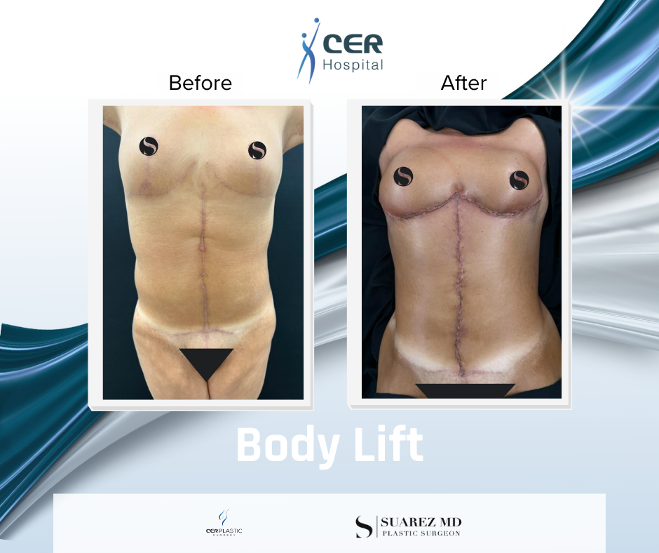 Body Lift - 020426