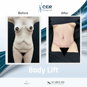 Body Lift – 050226