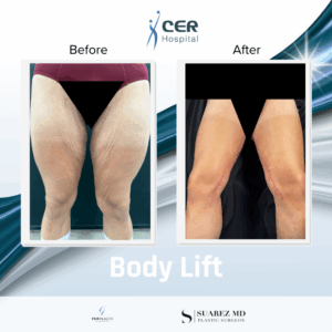 Body Lift – 260126