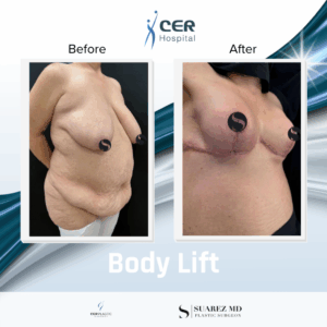 Body Lift – 290126